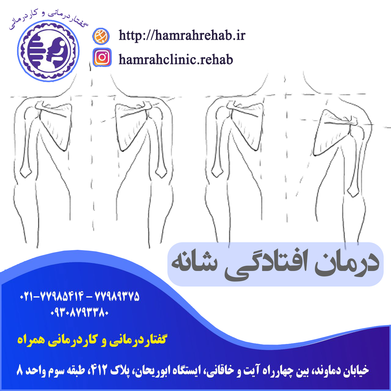 درمان افتادگی شانه در شرق تهران