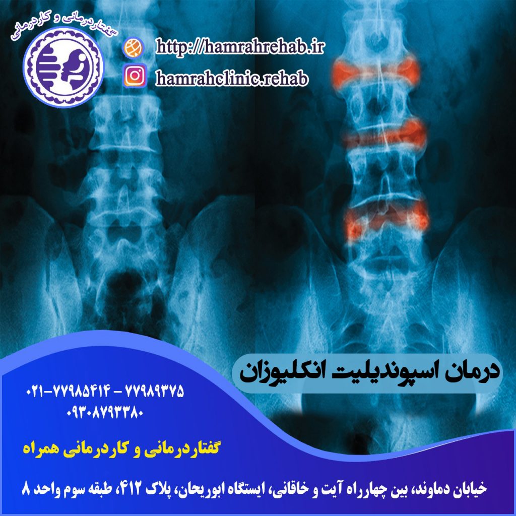 درمان اسپوندیلیت انکلیوزان در شرق تهران