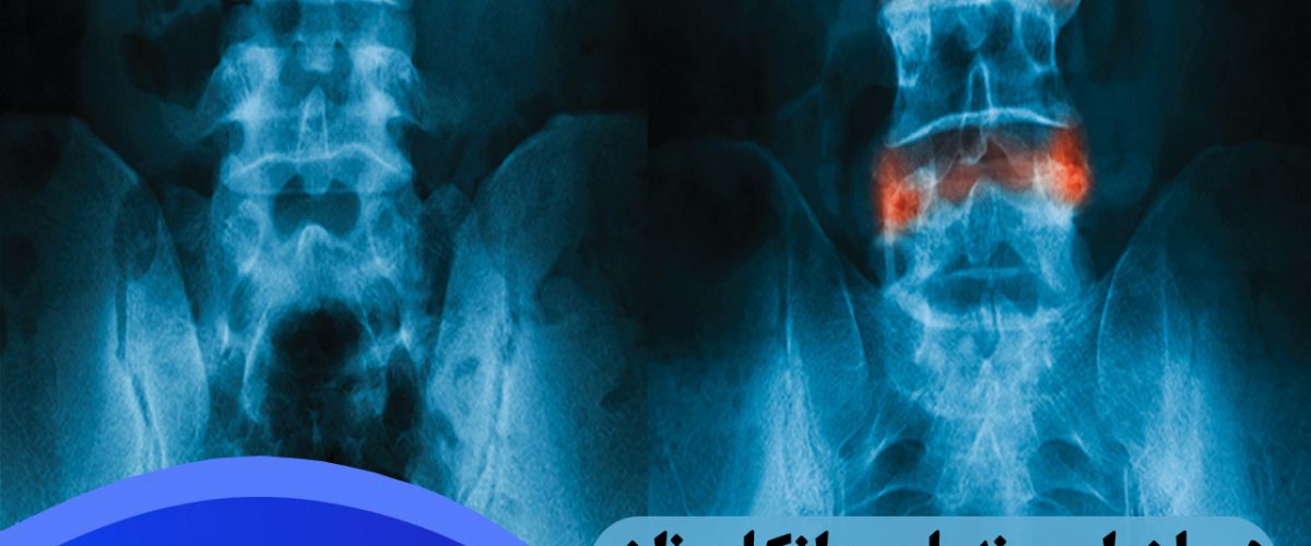 درمان اسپوندیلیت انکلیوزان در شرق تهران