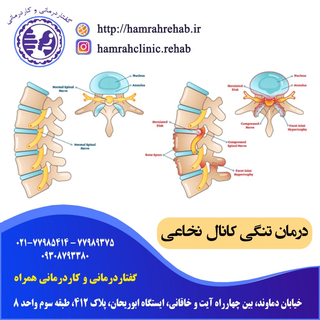 درمان تنگی کانال نخاع در شرق تهران