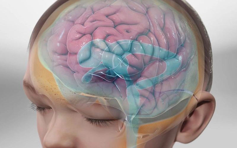 سندرم دندی واکر 