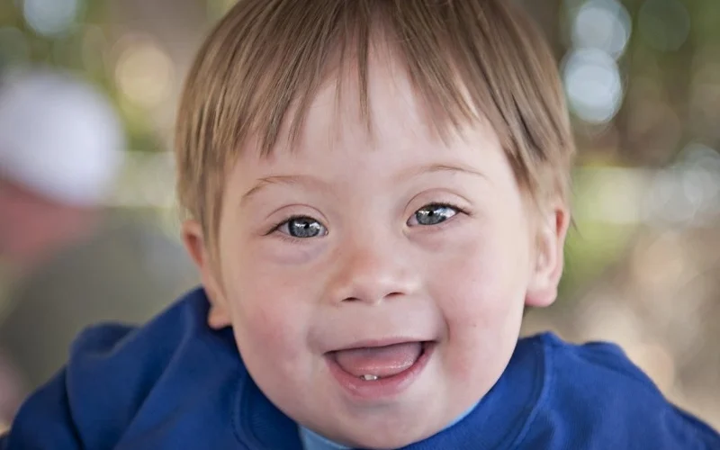 سندرم داون چیست؟