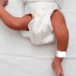 دررفتگی مادرزادی لگن نوزاد