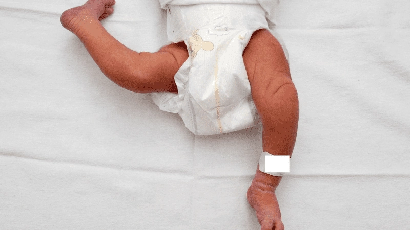 دررفتگی مادرزادی لگن نوزاد