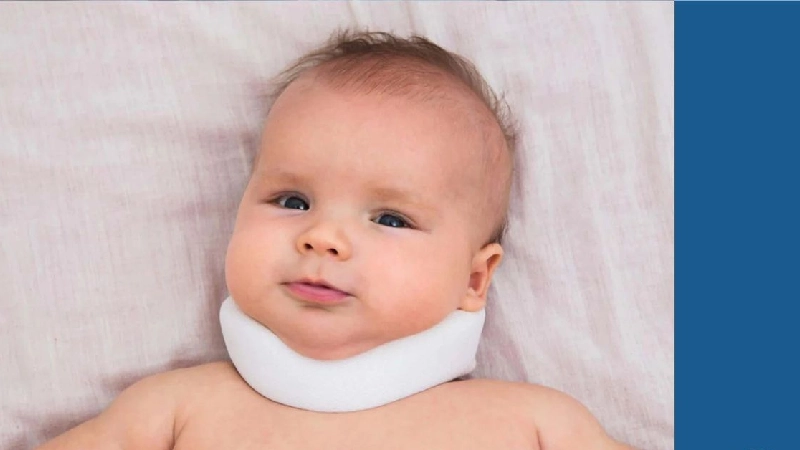 کج گردنی نوزاد