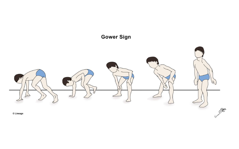 دیستروفی عضلانی چیست؟
