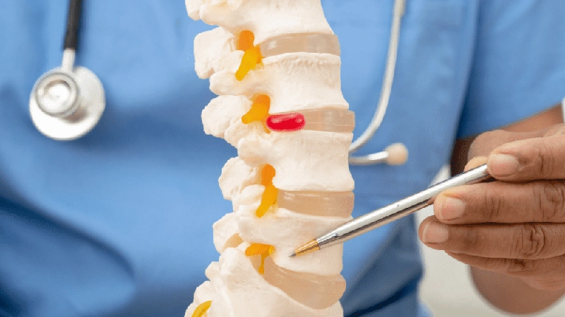 اسپوندیلیت آنکیلوزان